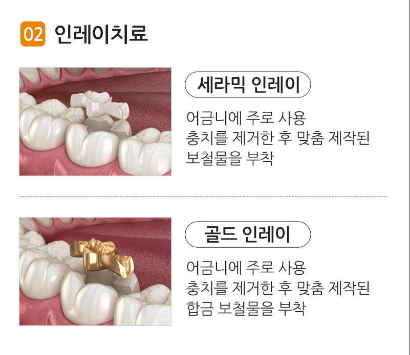 인레이치료