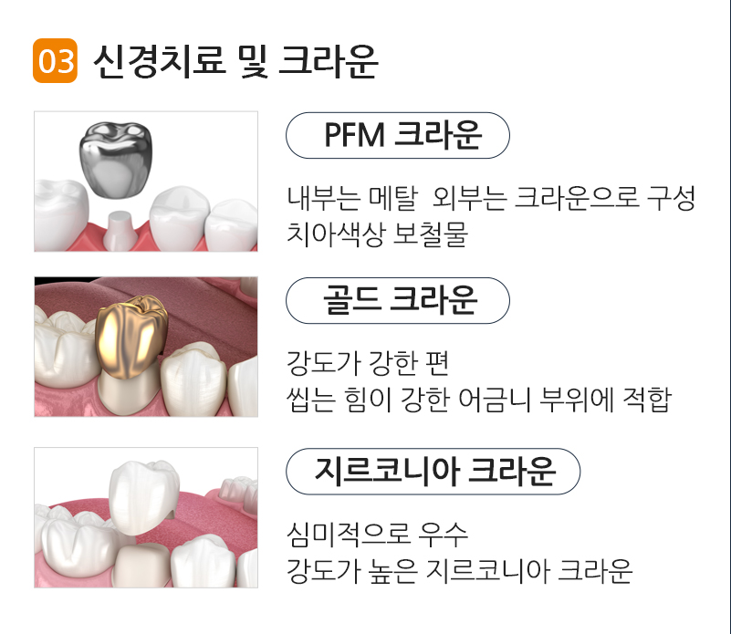 신경치료 및 크라운