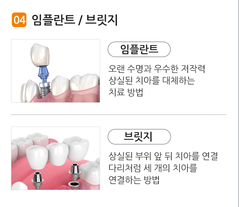 임플란트/브릿지